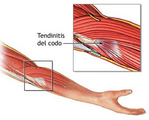 Tendinitis del codo 